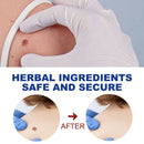 Wart Removal Mole Remedy Liquid Pen Treatment Papillomas Removing Skin Labels Flat Wart Genitals Painless Beauty Herbal Cream